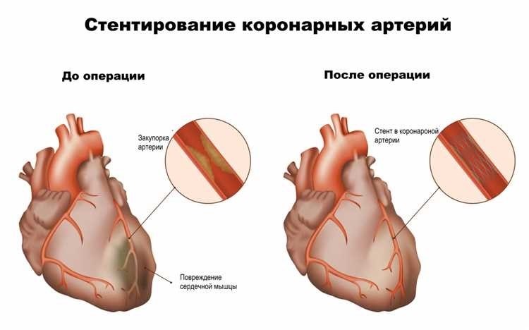 Почему после стентирования важно продолжать лечение