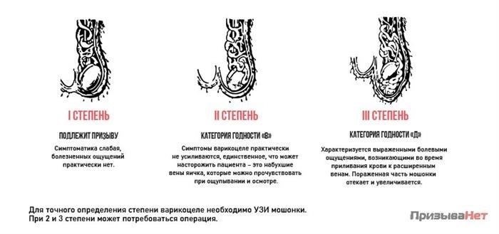 Пригодность к военному призыву при варикоцеле 2-й степени
